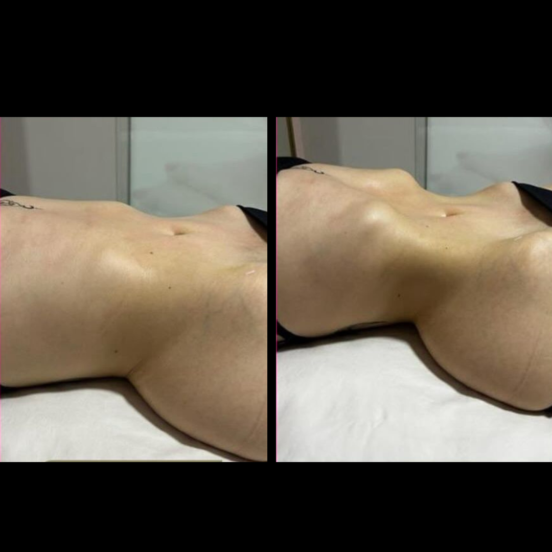 Antes e depois